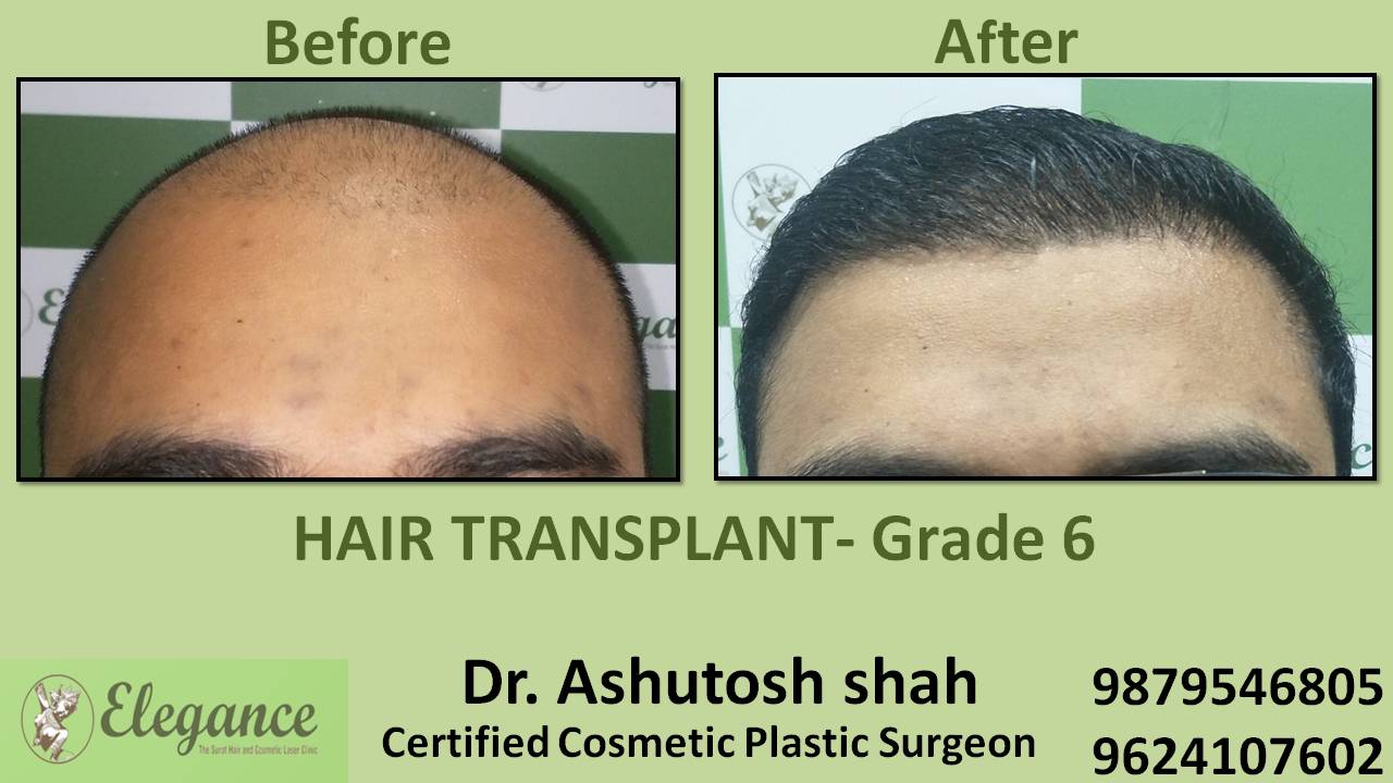 Hair Transplant grade 6 Mumbai, Maharashtra, India