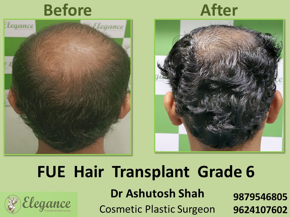 Hair Baldness, Hair Regrowth, Grade 6 in Vesu, Surat