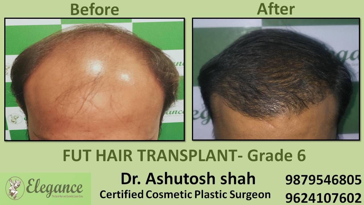 hair loss treatment in gujarat