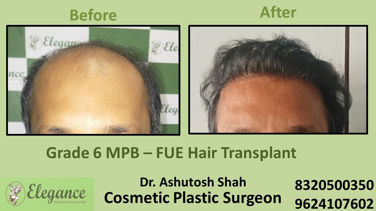 Hair Regrowth Treatment, Grade 6 with FUE Method in Vesu, Surat