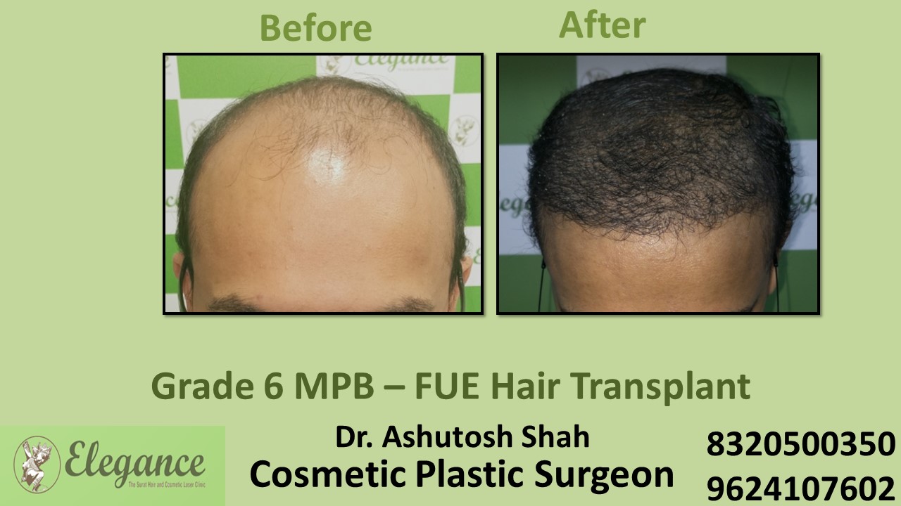 Hair Regrowth Treatment, Grade 6 with FUE Method in Vesu, Athwagate, Surat