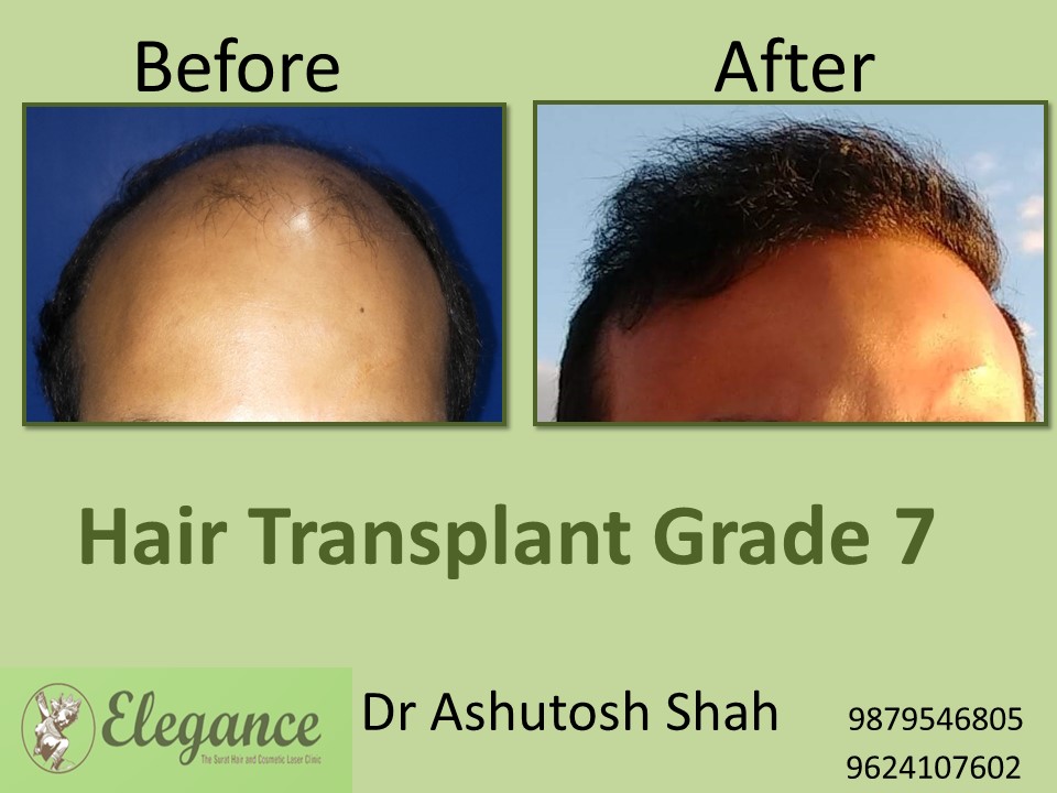 Grade 7 Hair Transplant Cost In Surat, Gujarat, India