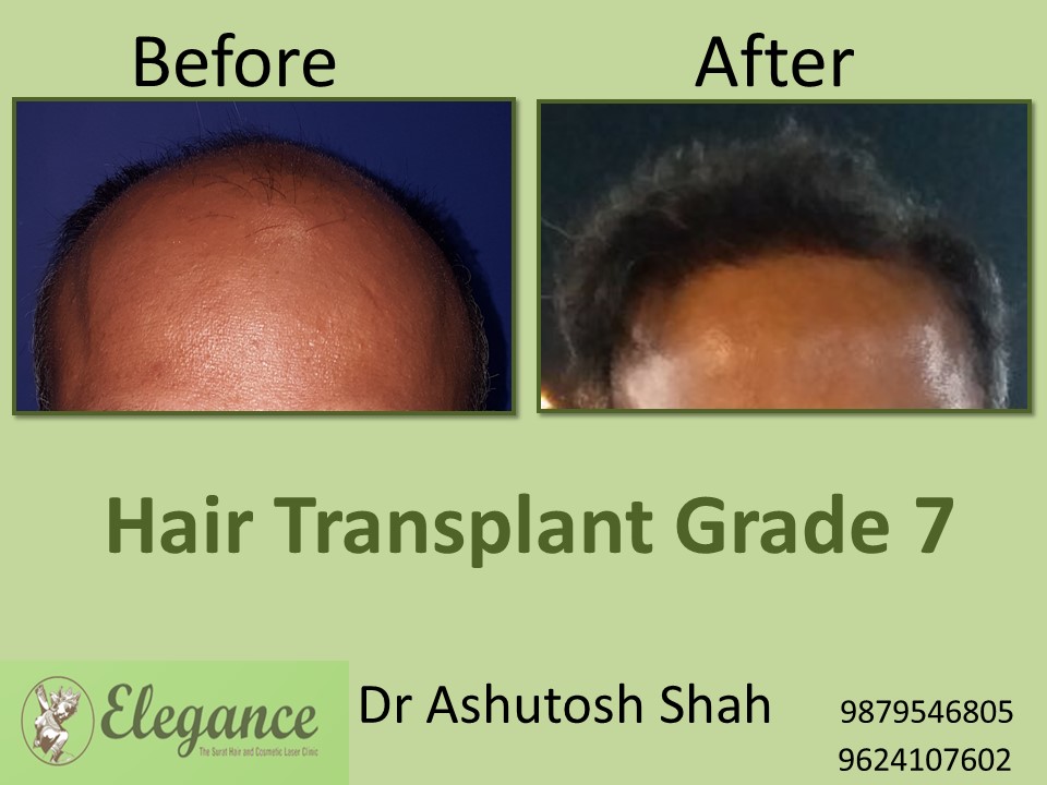 Grade 7 Hair Transplant Doctor In Surat, Gujarat, India