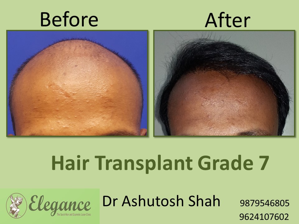 Grade 7 Hair Transplant Surgery In Surat, Gujarat, India