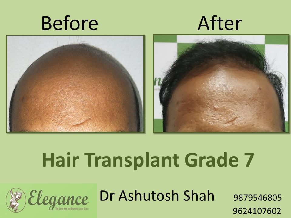 Grade 7 Hair Transplant Before And After In Surat, Gujarat, India