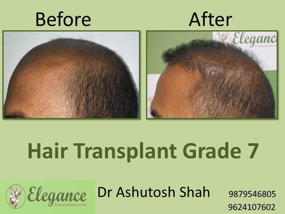 Grade 7 Hair Transplant Result In Surat, Gujarat, India