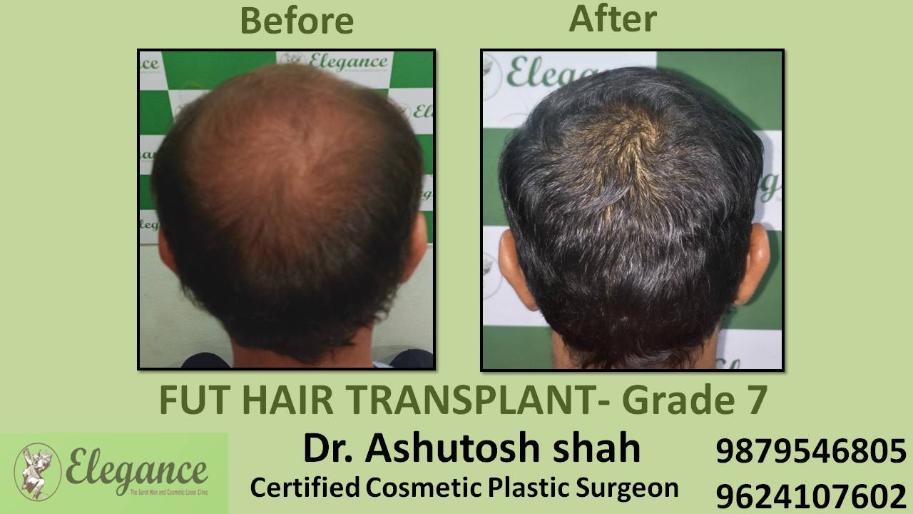 Grade 7 hair transplant in surat gujarat