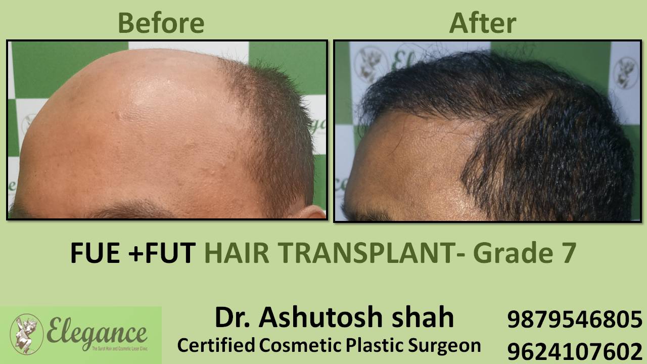 Combination Hair Transplant Patna, Bihar, India