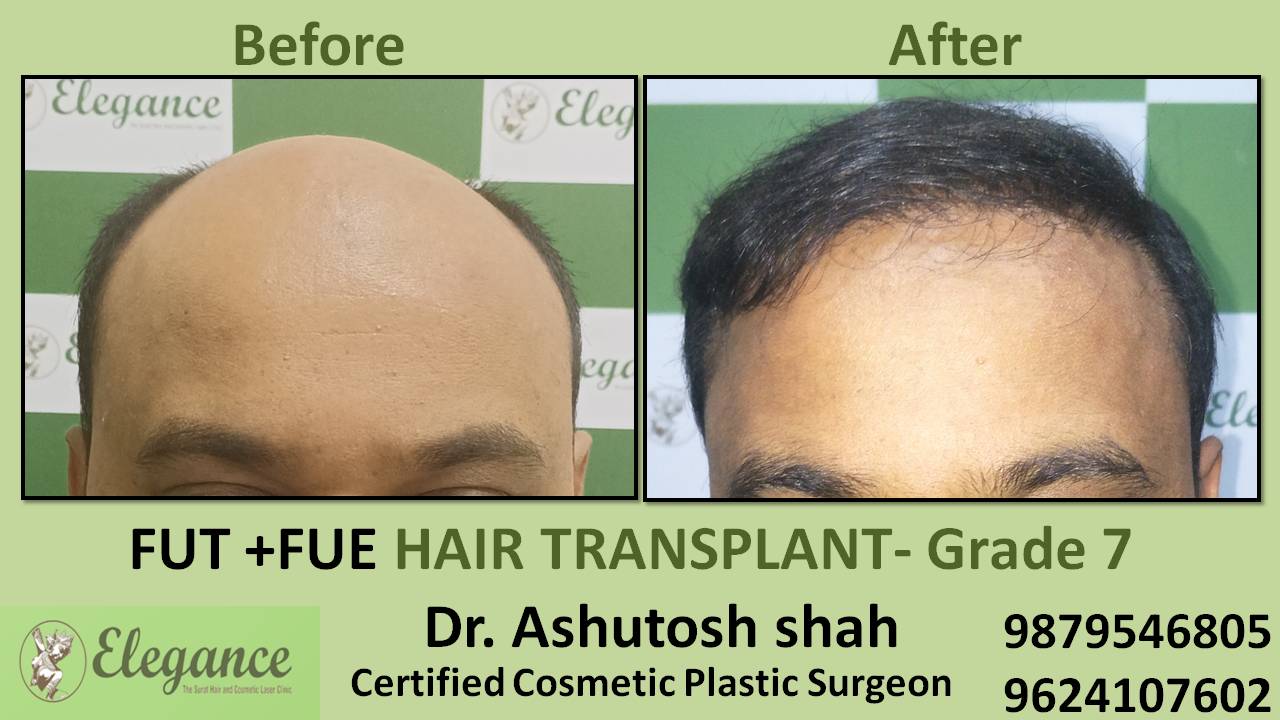 Combination Hair Transplant Baroda, Gujarat, India