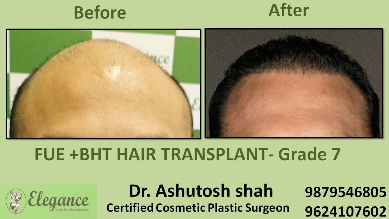 Combination Hair Transplant Before After Bharuch, Gujarat, India