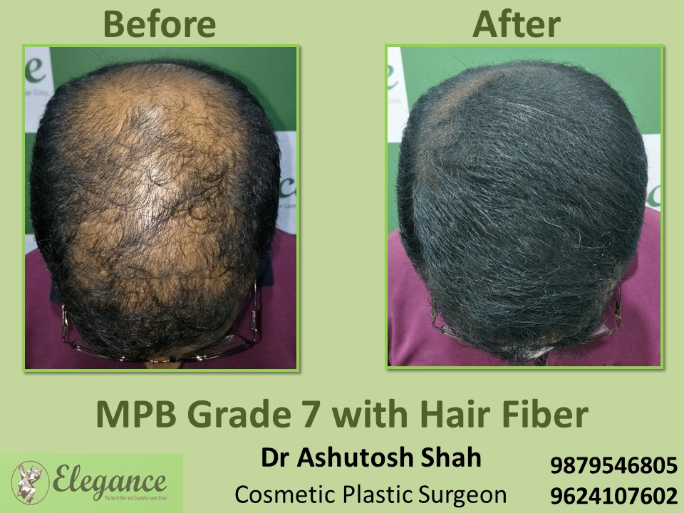 MPB Grade 7 with Hair Fibre in Vesu, Surat