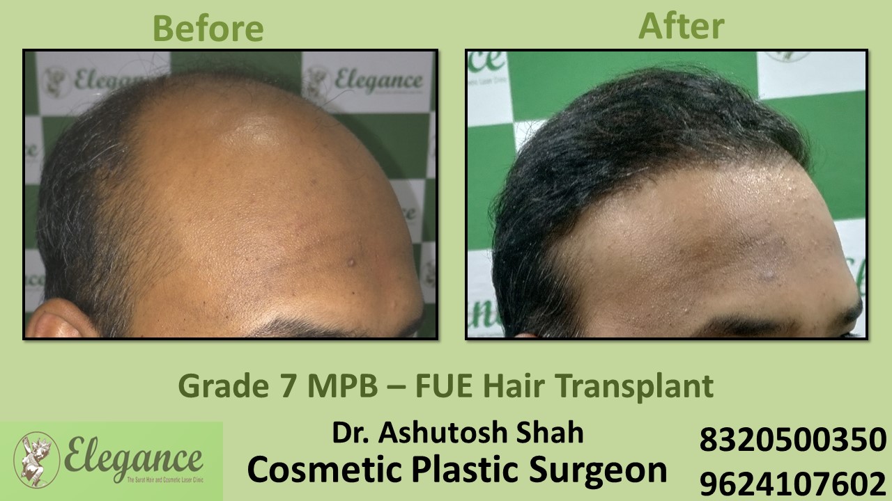 Grade 7, Hair Transplant Treatment in Vesu, Piplod, Surat
