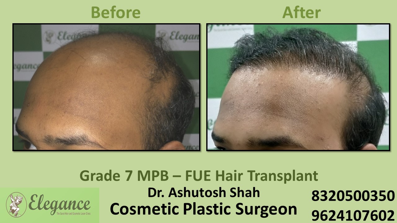 Grade 7, Hair Transplant Treatment in Piplod, Surat
