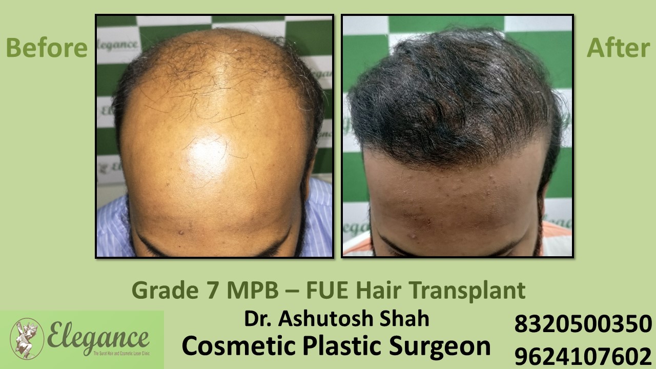 Grade 7, Hair Transplant Treatment, Hair Regrowth in Surat