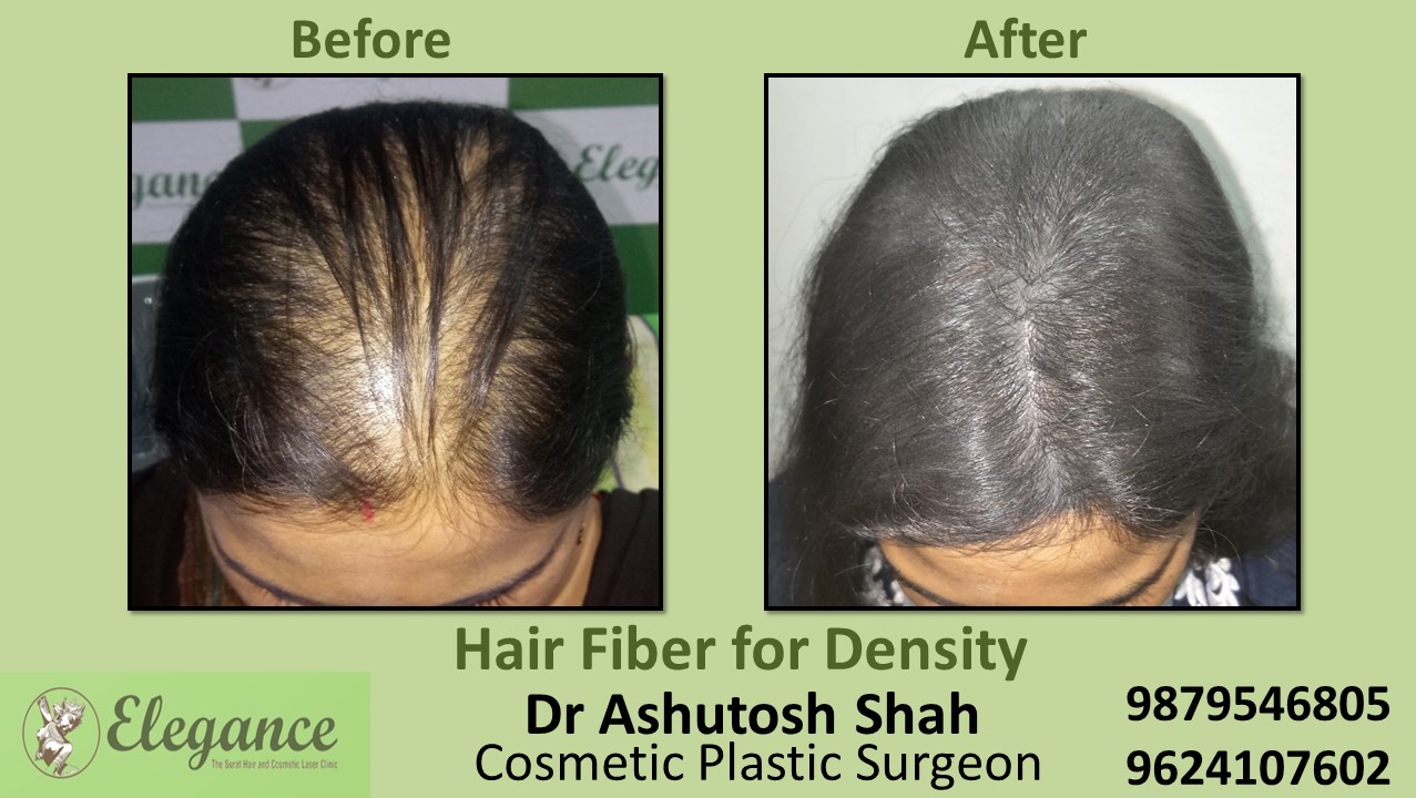 Hair Fiber Treatment in Ankleshwar, Gujarat