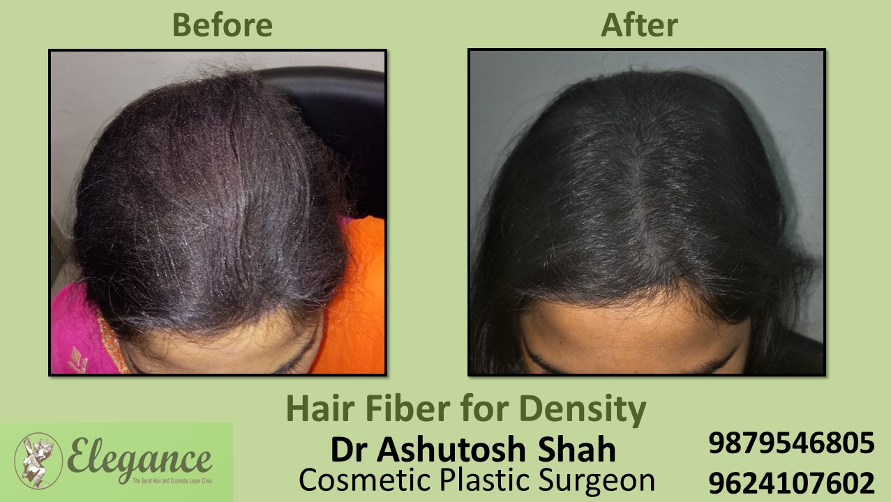 Hair Fiber Treatment in Baroda, Gujarat