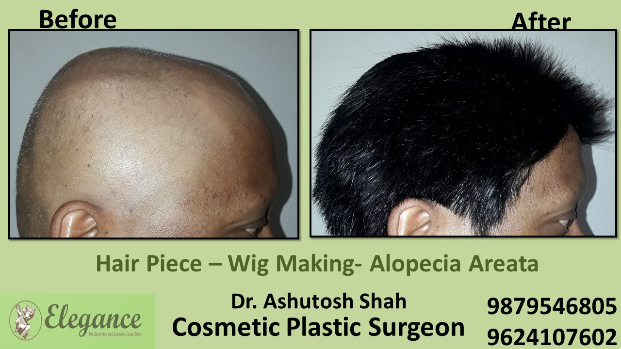 Hair Piece Treatment in Ankleshwar, Surat