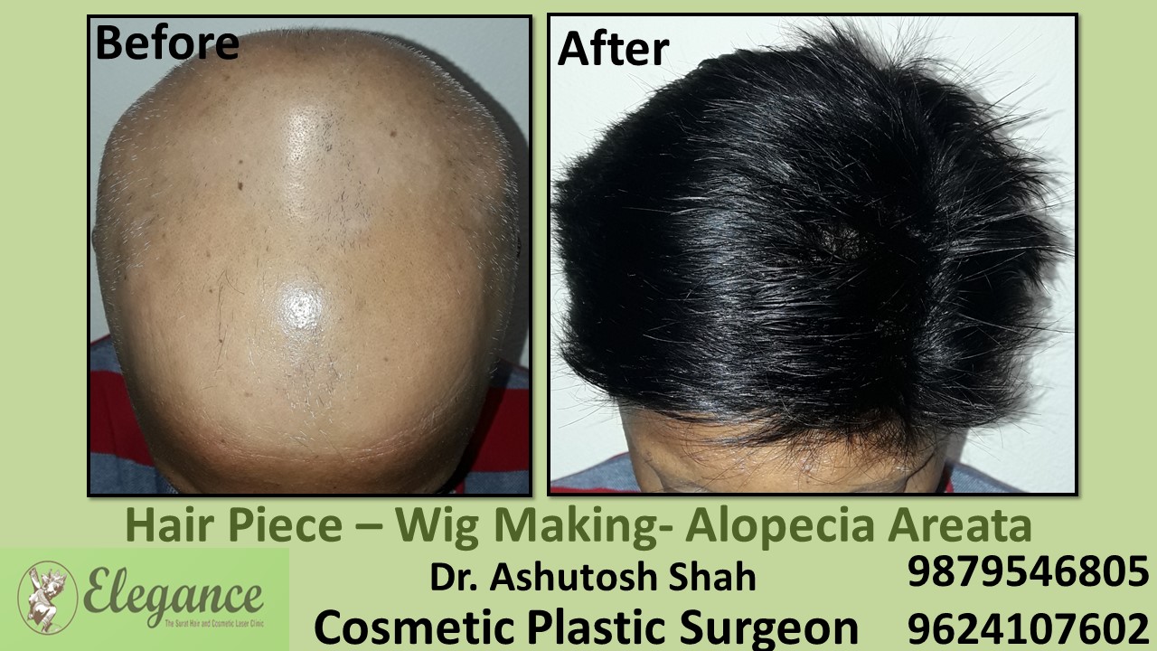 Hair Piece Treatment in Bharuch, Surat