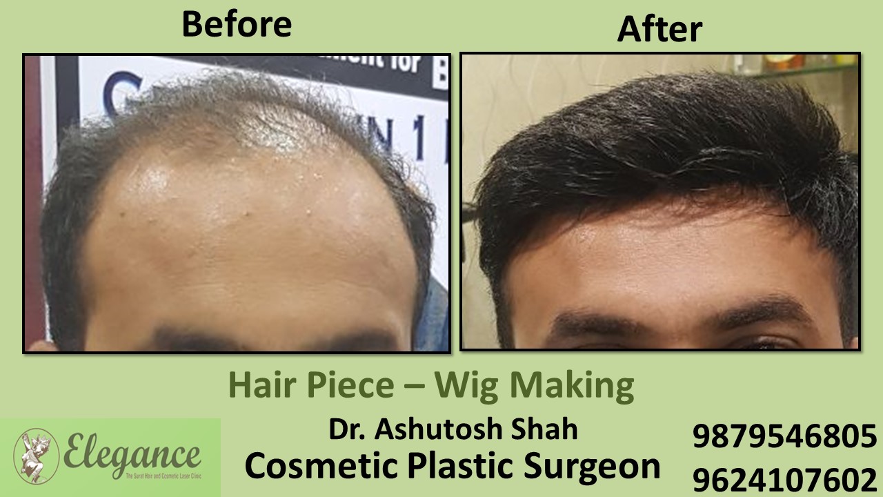 Hair Piece Treatment in Kim, Surat