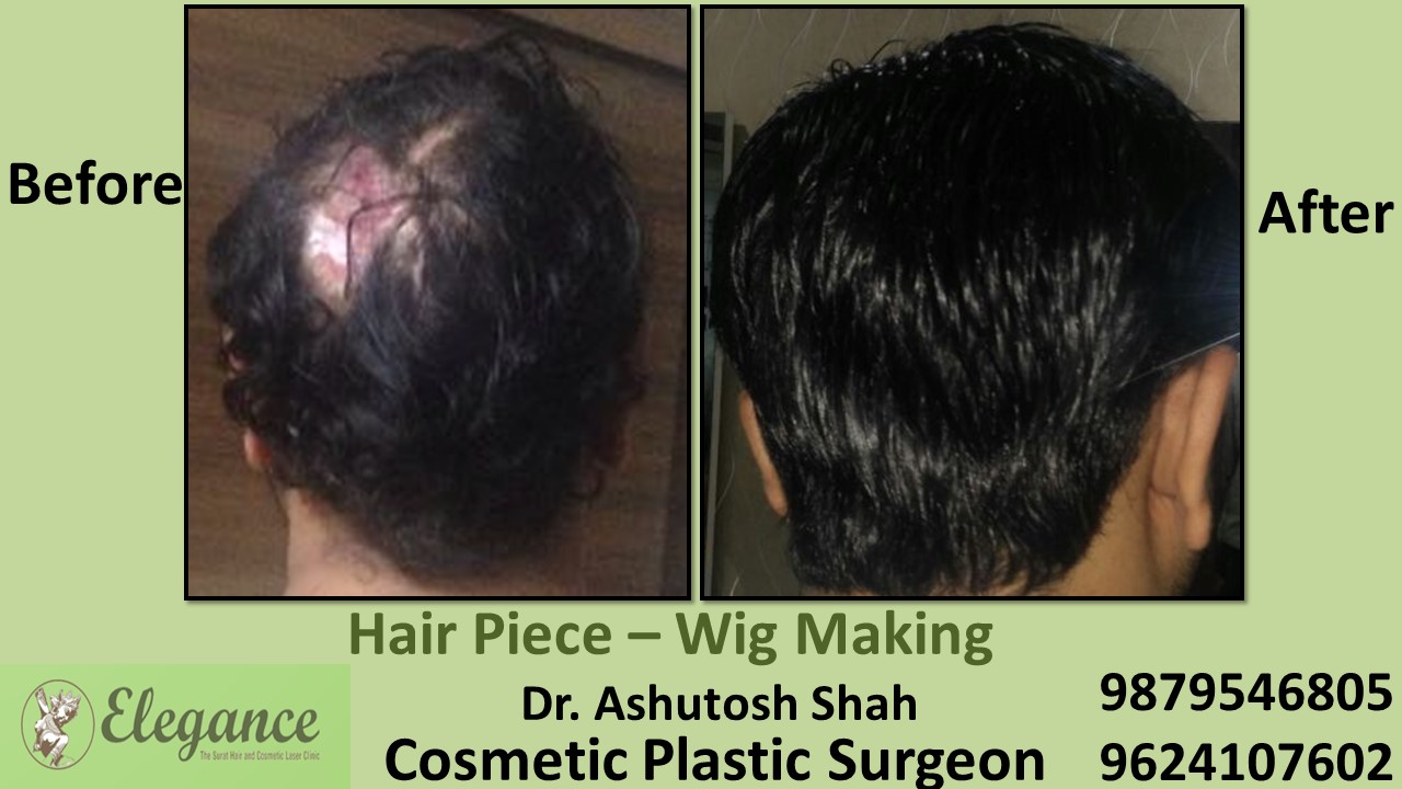 Hair Piece Treatment in Valsad, Surat