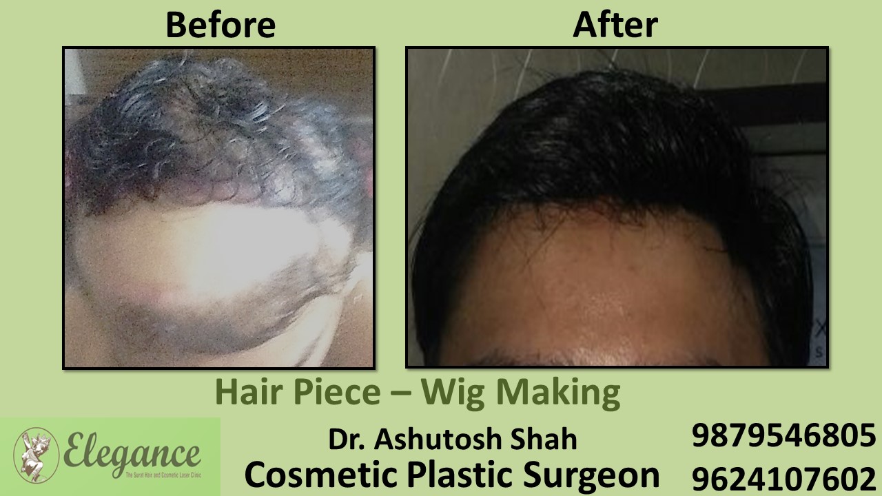 Hair Piece Treatment in Vapi, Surat