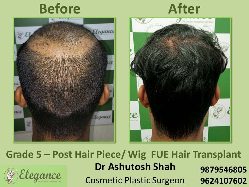 Post Hair Piece, Wig FUE Hair Transplant, Grade 5 in Vesu, Athwagate, Surat