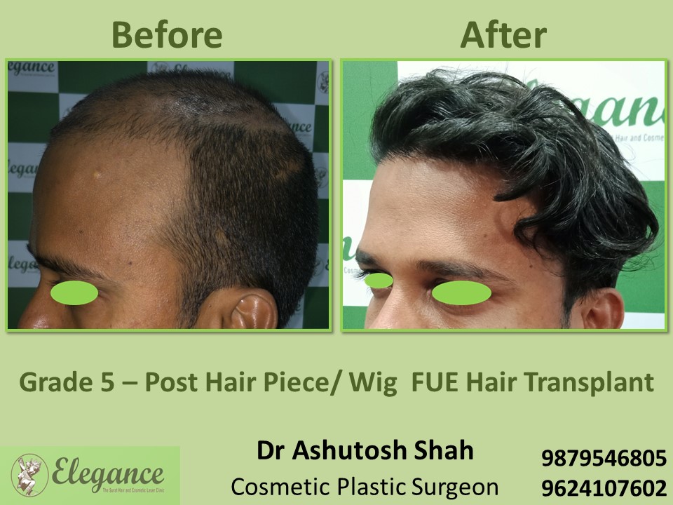 Post Hair Piece, Wig FUE Hair Transplant, Grade 5 in Vesu, Piplod, Surat