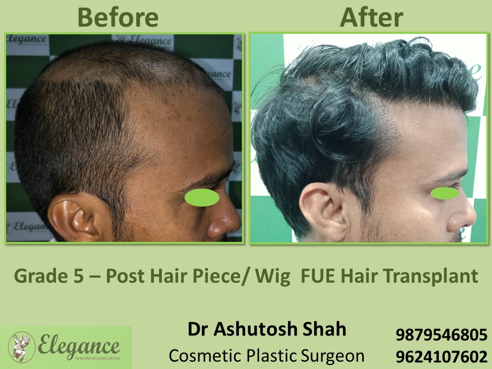 Post Hair Piece, Wig FUE Hair Transplant, Grade 5 in Vesu, Surat