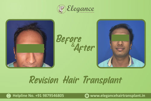 Hair Transplant Clinic in Vapi, Gujarat, india