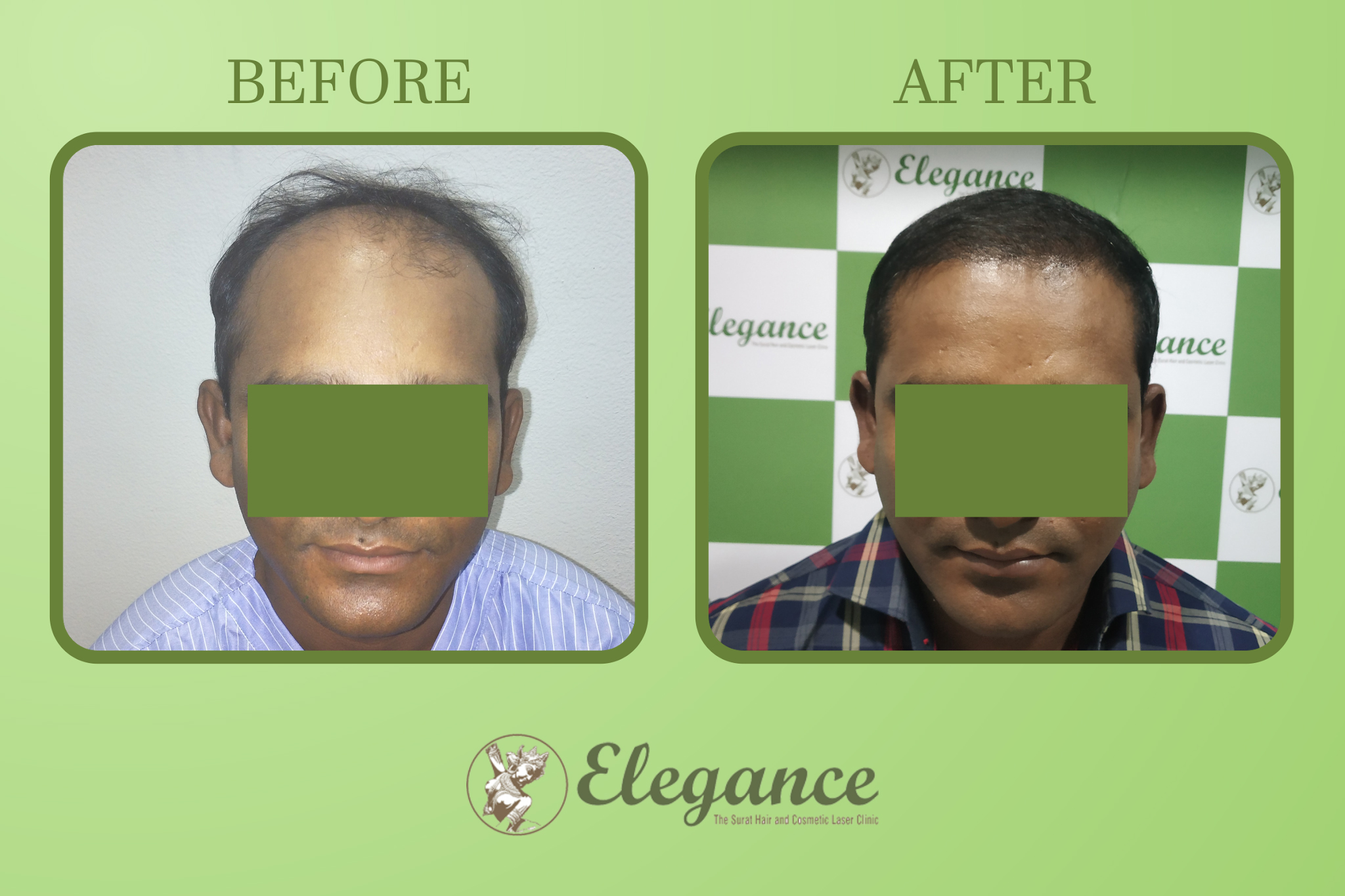 Hair Transplant Doctor Near Adajan, Surat, Gujarat, India