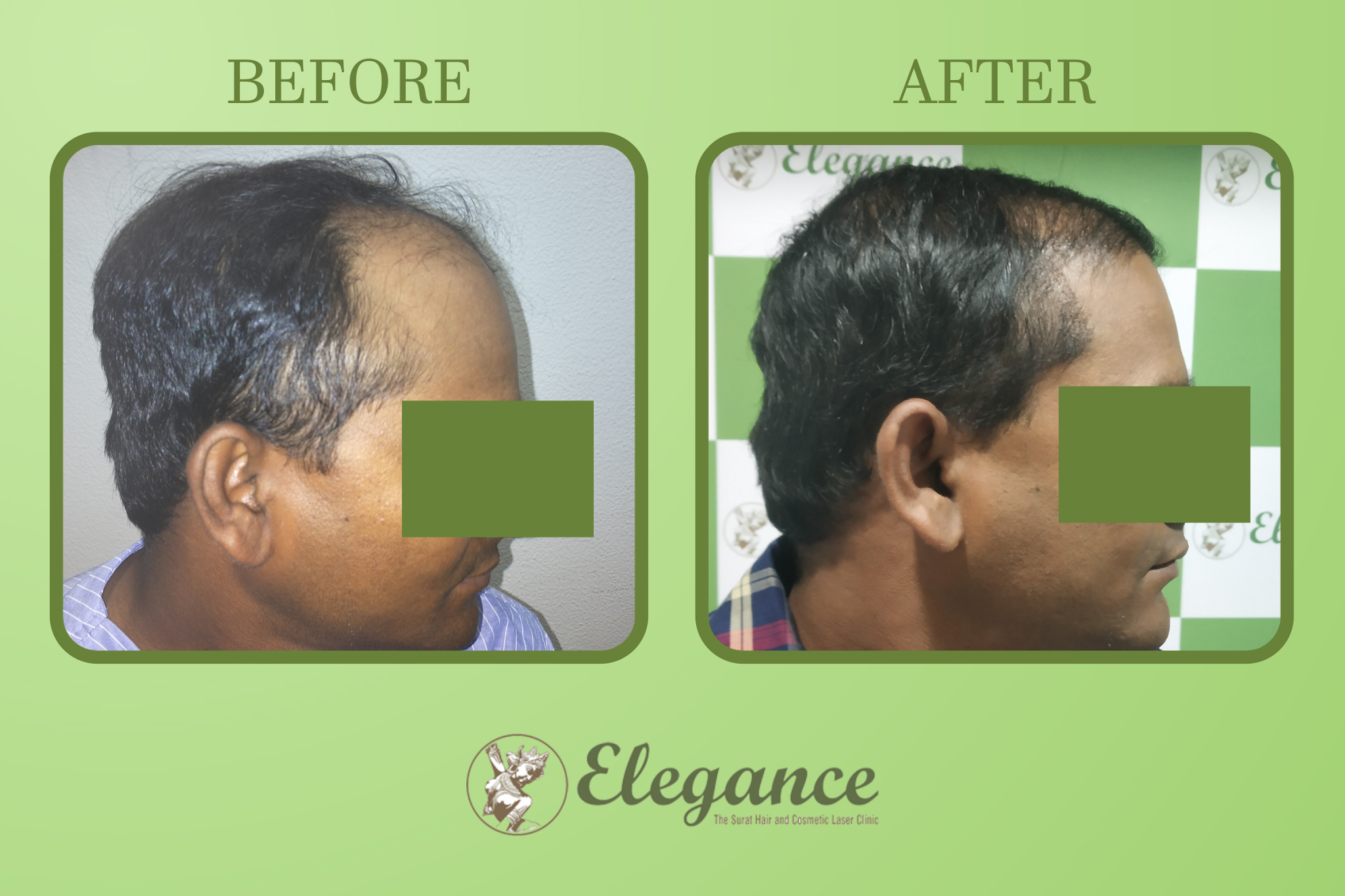 Hair Transplant Doctor Near Vesu, Surat, Gujarat, India