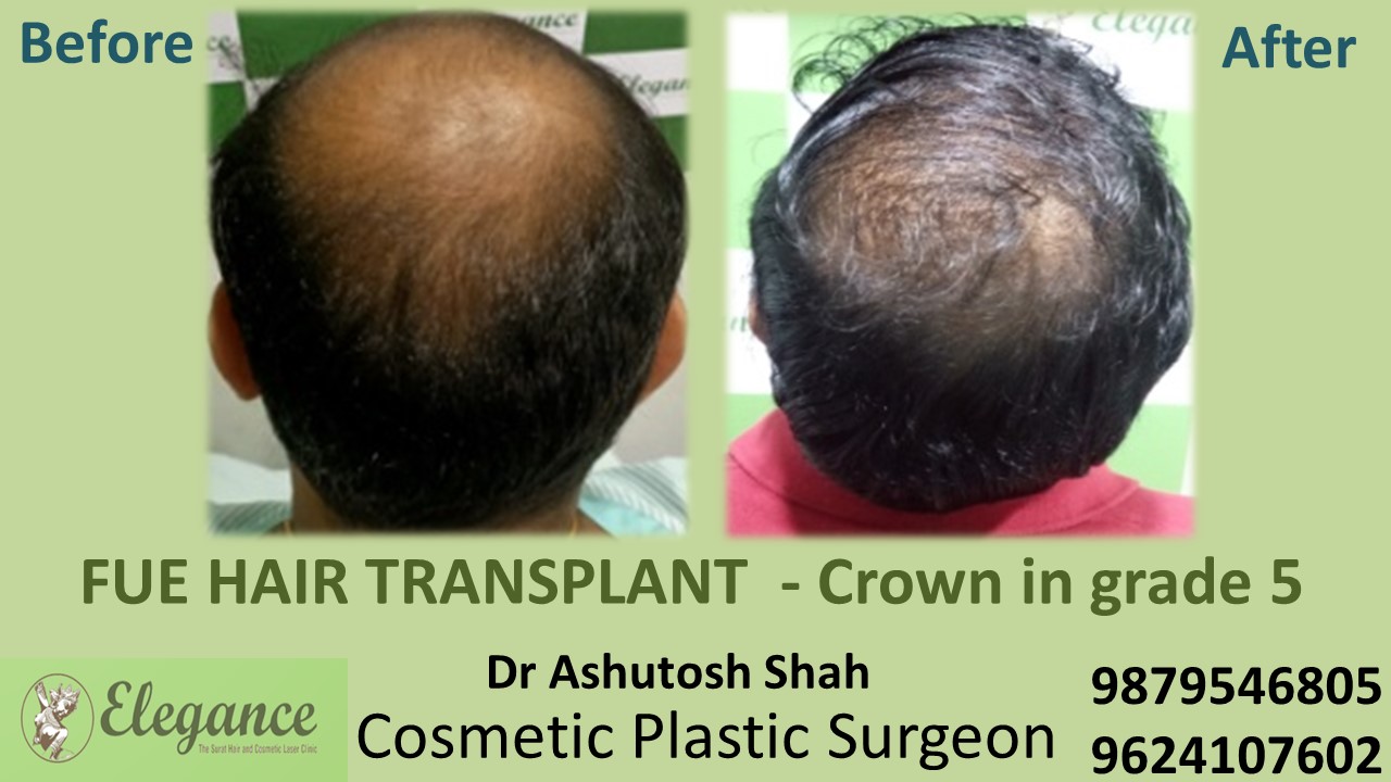Hair Transplant FUE In Valsad Gujarat India