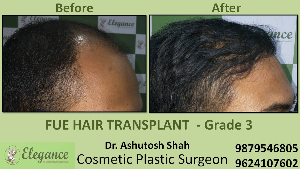 Hair transplant Grade 3 In Surat, Gujarat, India