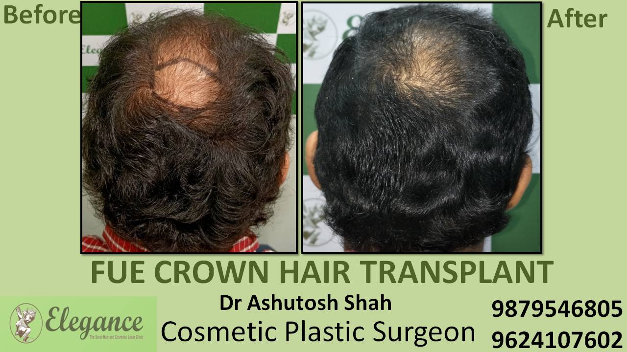 Hair transplant In Anand, Gujarat, India