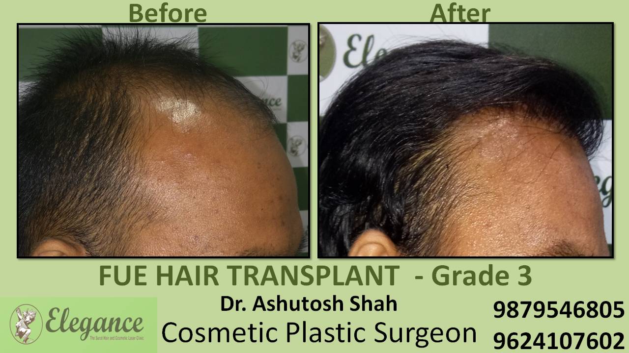 Hair transplant Grade 3 In Pune, Maharashtra, India