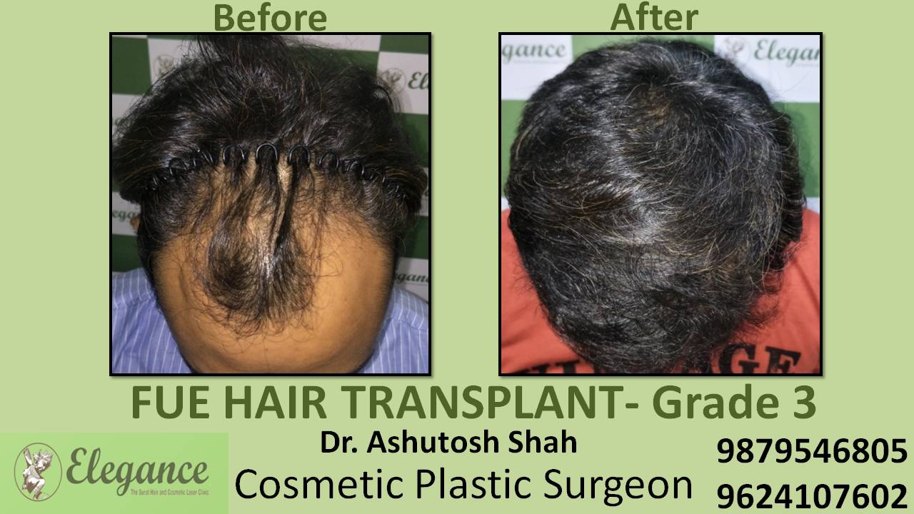 Hair transplant Grade 3 In Nasik, Maharashtra, India