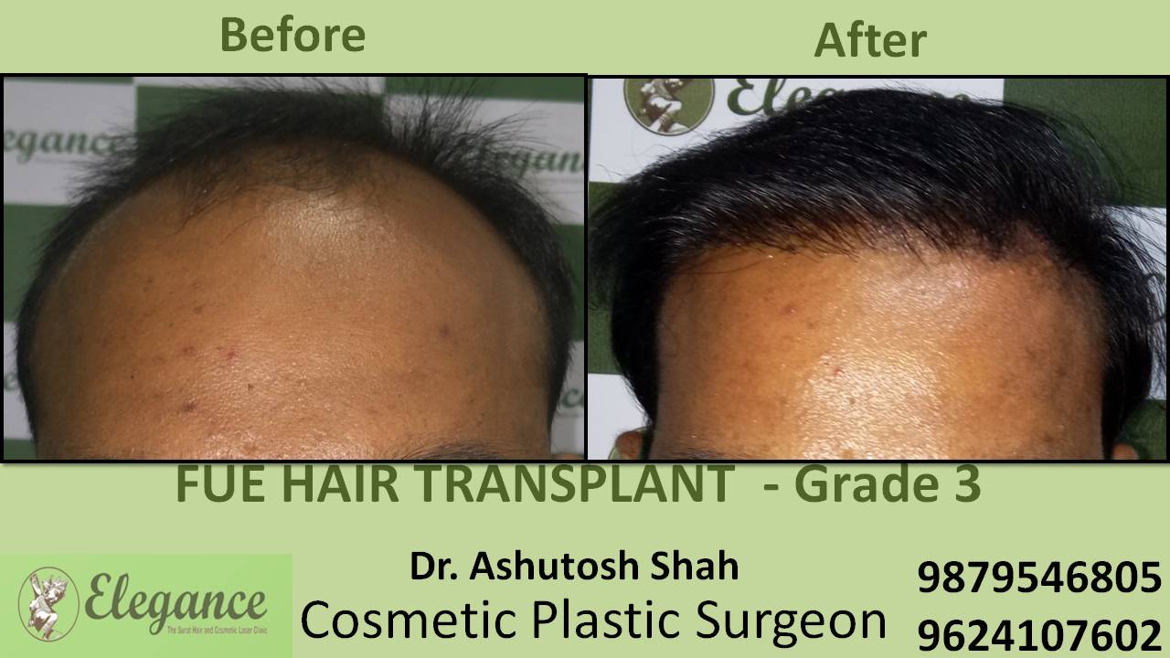 Hair transplant Grade 3 India