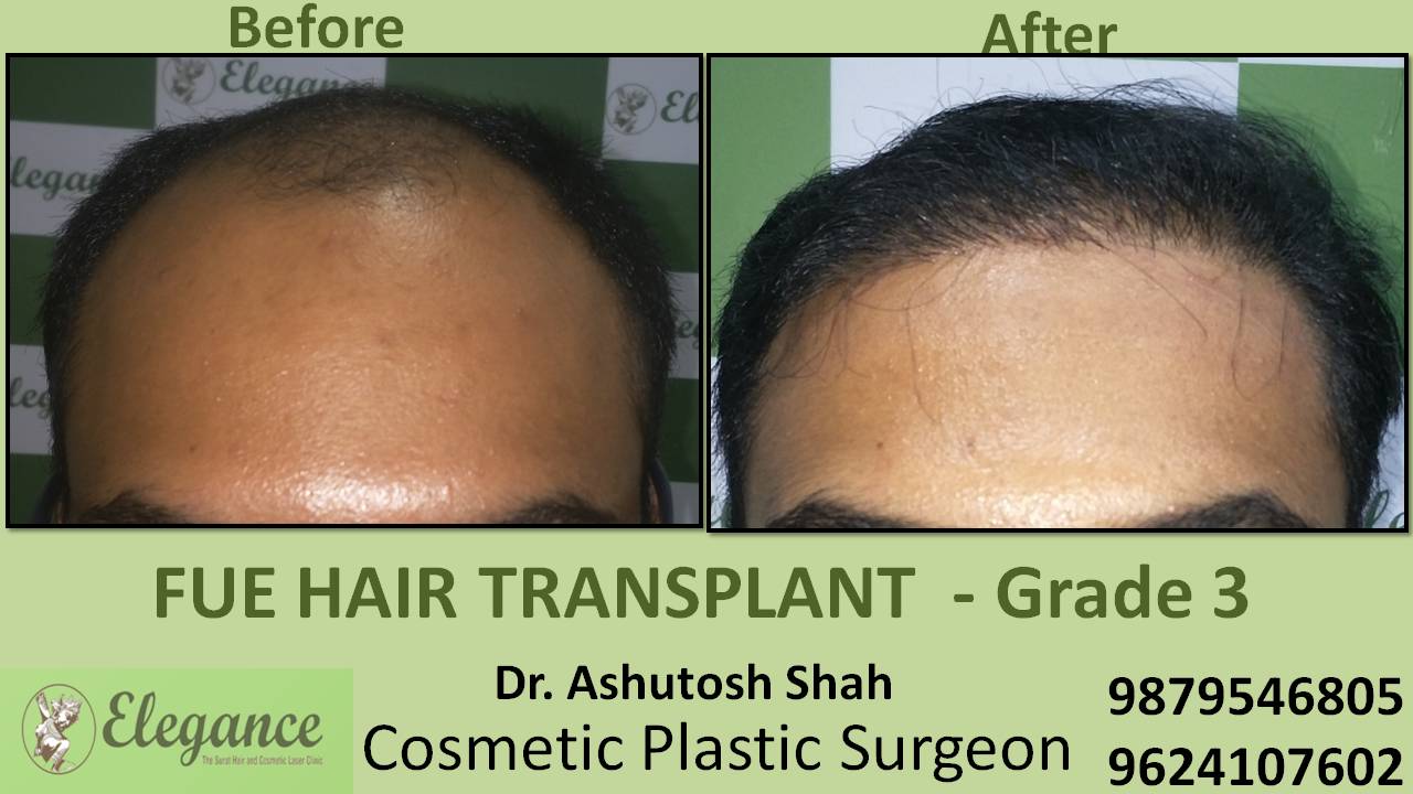 Hair transplant Grade 3 In Bharuch Gujarat, India