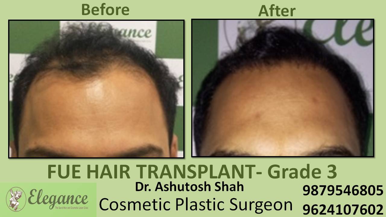 Hair transplant Grade 3 Cost In Delhi, India