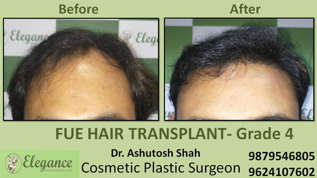 Hair Transplant Grade 4 In Vesu, Surat, Gujarat, India