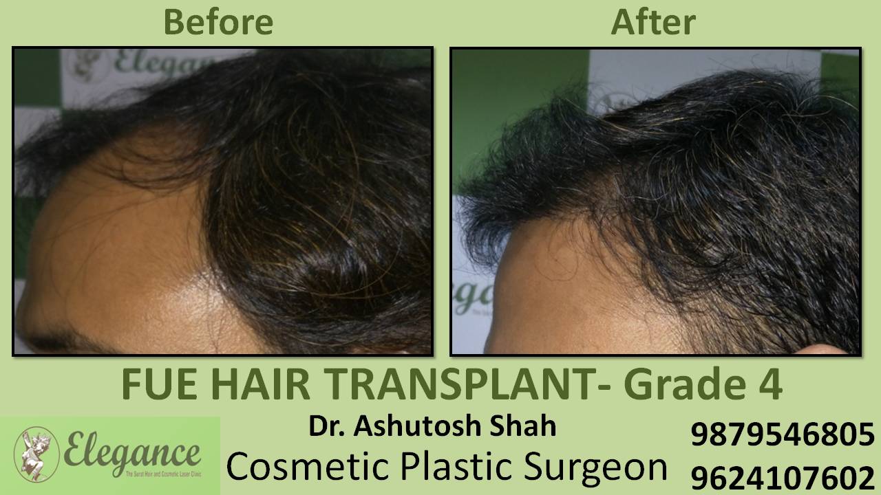 Hair Transplant Grade 4 In Diu, Gujarat, India
