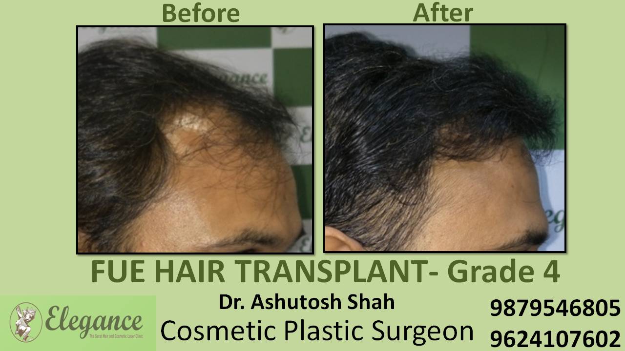 Hair Transplant Grade 4 In Anand, Gujarat, India