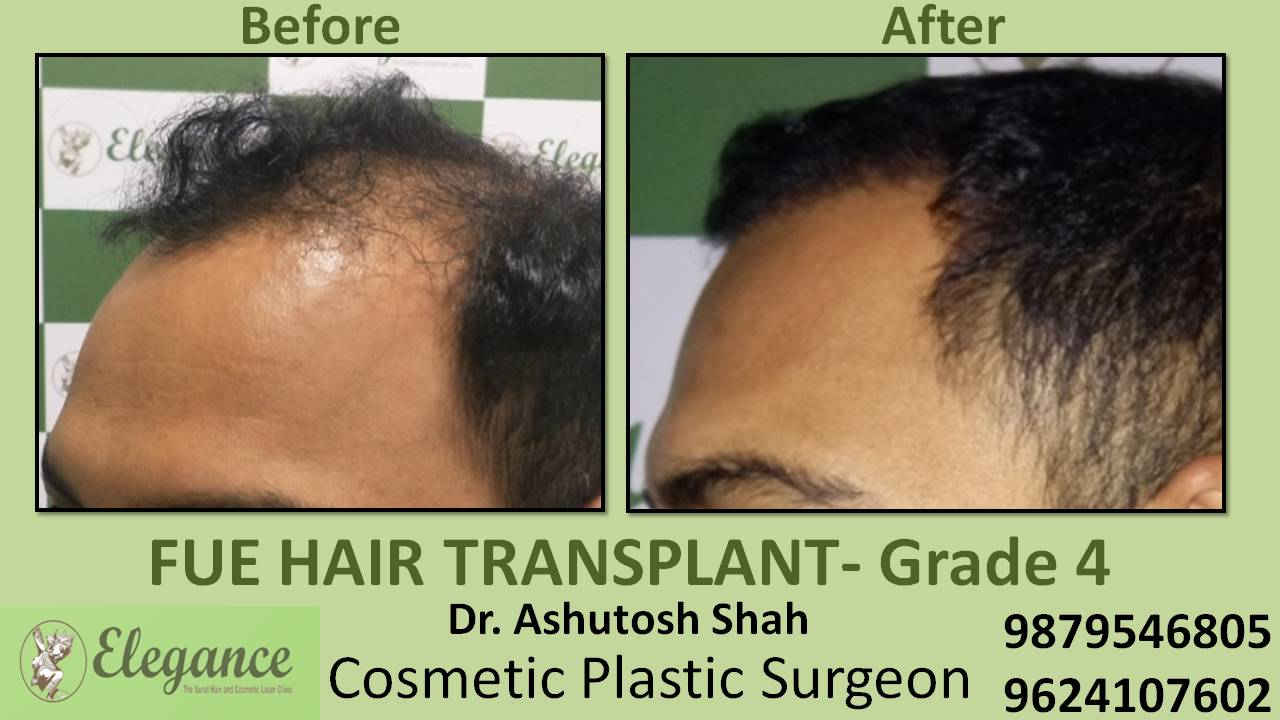Hair Transplant Grade 4 In Mumbai, Maharashtra, India