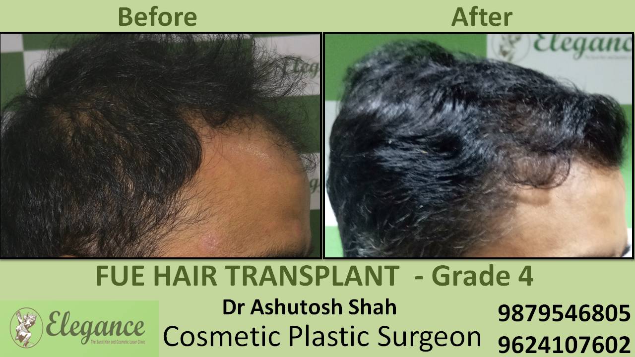 Hair Transplant Grade 4 In Pune, Maharashtra, India