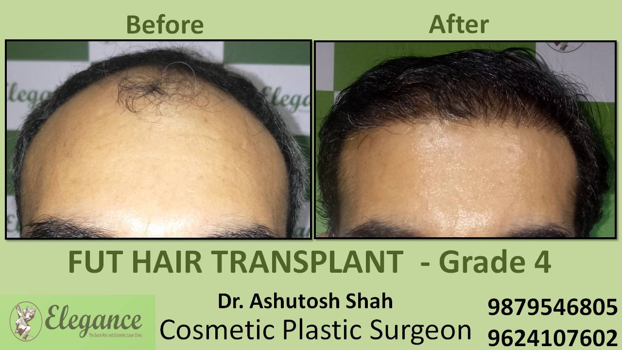 Hair Transplant Grade 4 Cost In Mumbai, Maharashtra India