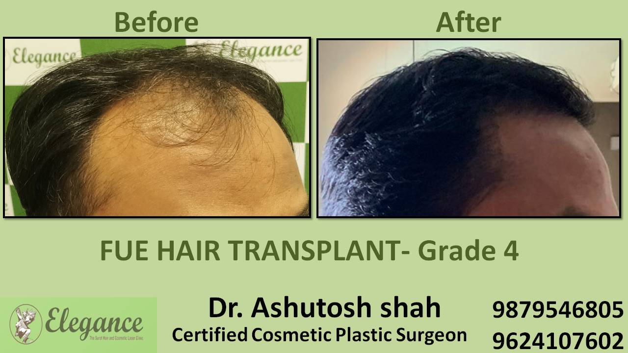 Hair Transplant Grade 4 Amroli, Surat, Gujart, India