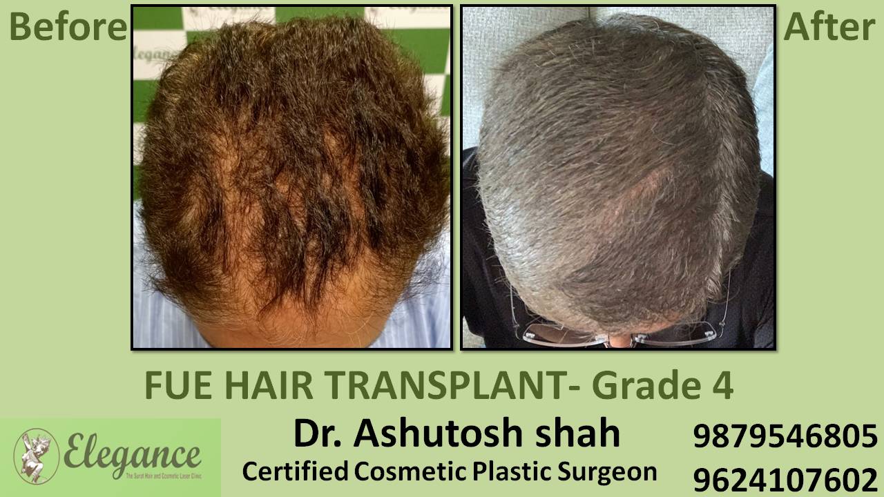 Hair Transplant Grade 4 Jodhpur, Rajasthan, India