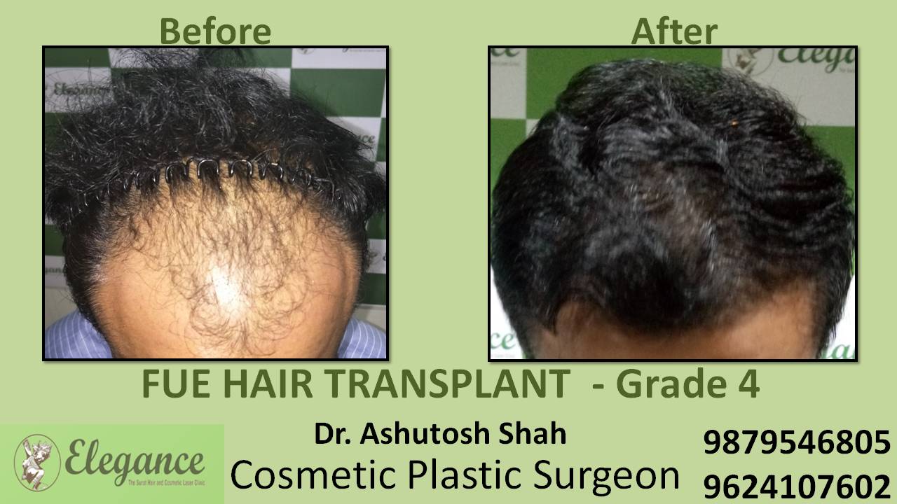 Hair Transplant Grade 4 Maroli, Gujarat, India