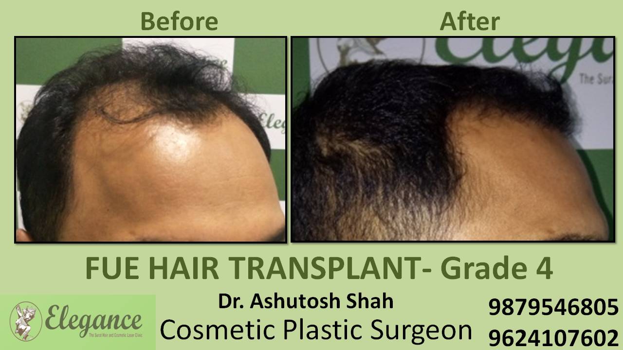 Hair Transplant Grade 4 Gujarat, India