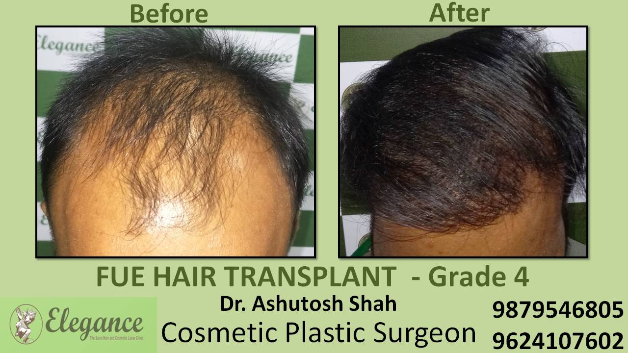 Hair Transplant Grade 4 In Bharuch, Gujarat, India